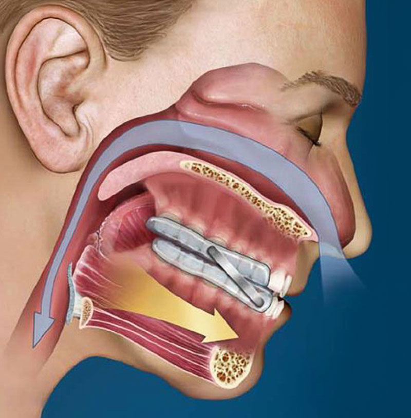 Orthèse d'avance mandibulaire Quies - Ronflements et apnée du sommeil